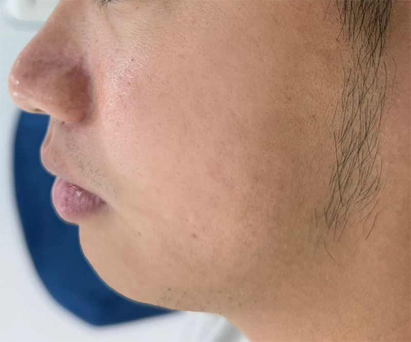 After acne scar treatment results