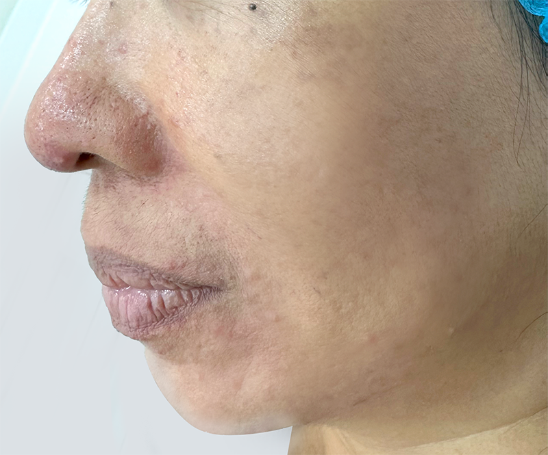 Acne scar treatment after results