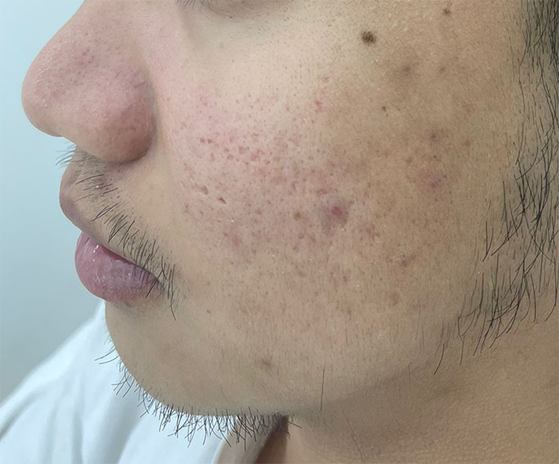 Before acne scar treatment condition
