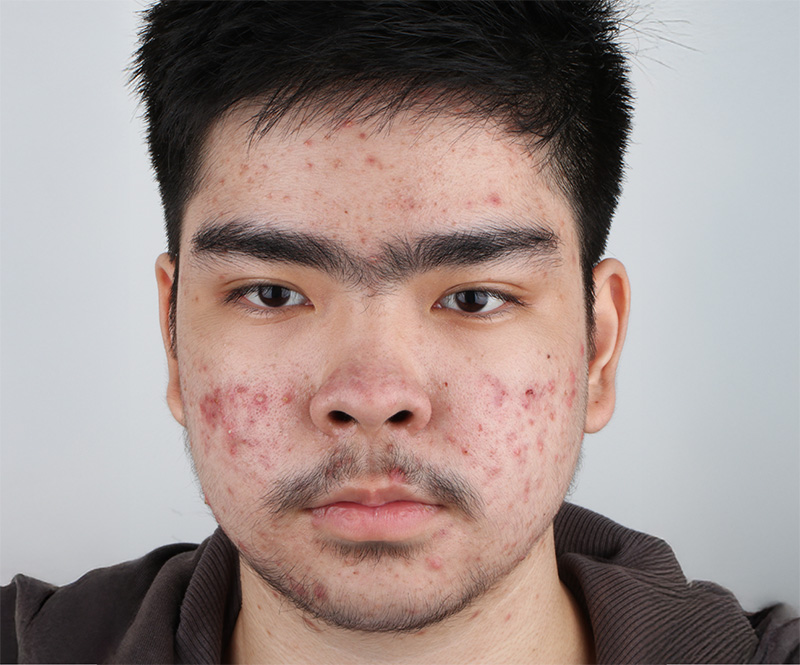 Acne scar treatment before results