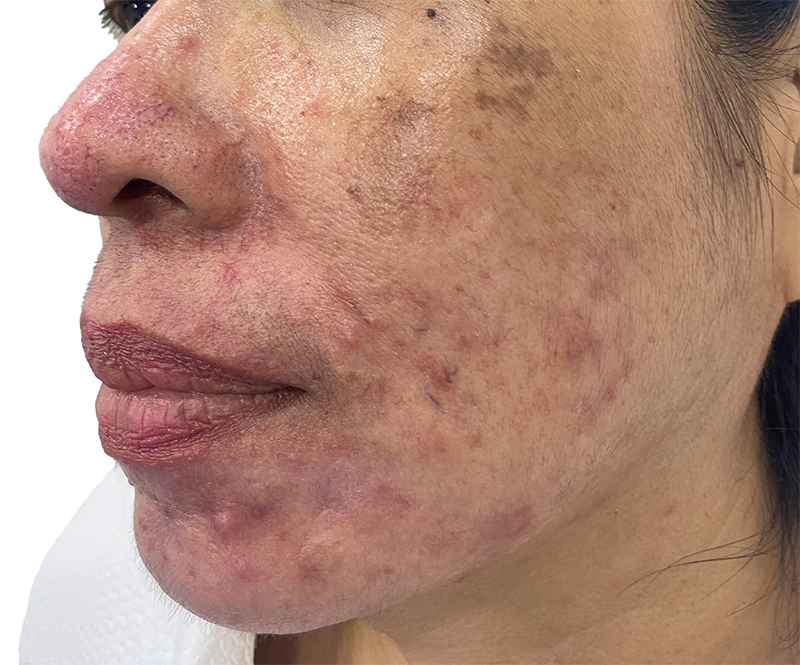 Acne scar condition before treatment