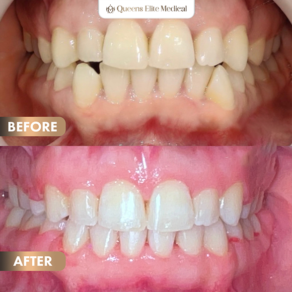 5BeforeAfter