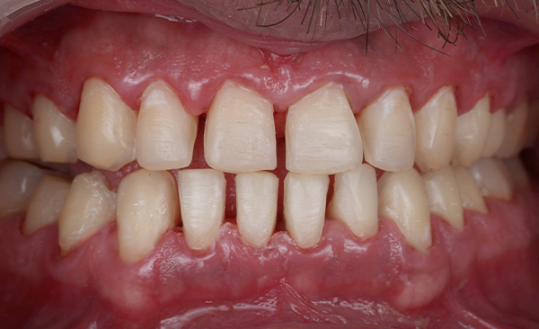 Patient before starting aesthetic treatment