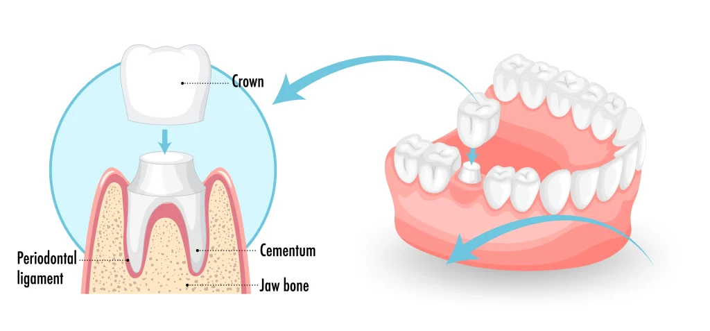 Dental crown treatment for damaged teeth