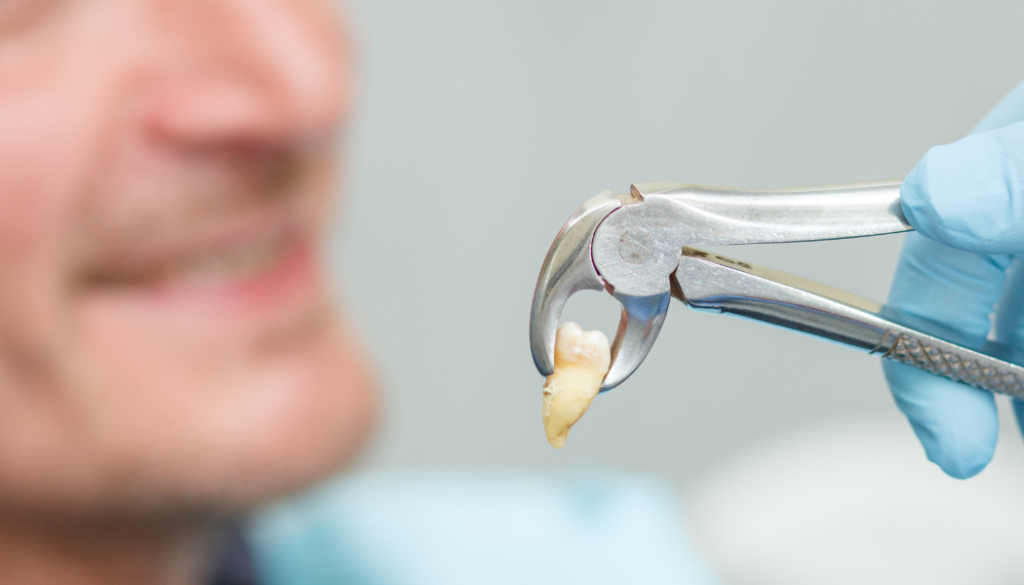 Preparing for a Surgical Tooth Extraction