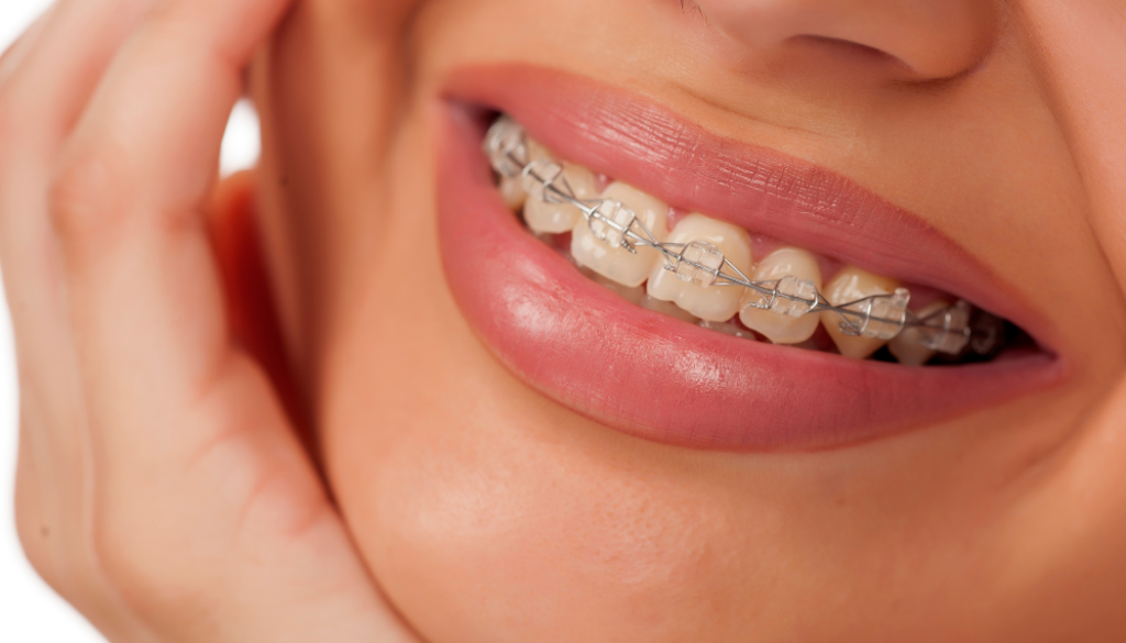 Right Time to Consider Braces